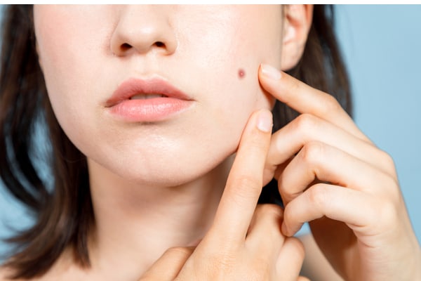 Woman checking her acne