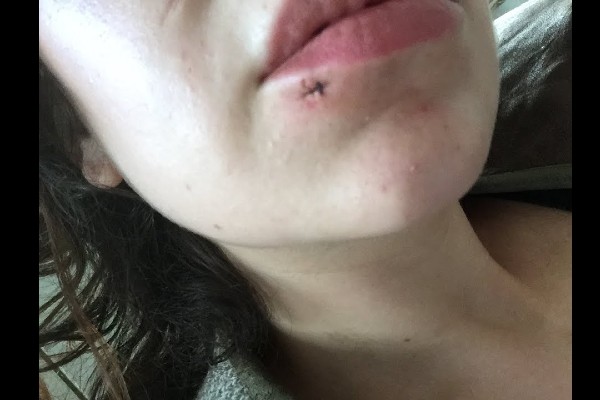 Getting a scar from labret piercings.