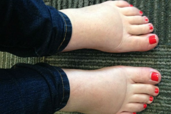 Swollen ankles are common during pregnancy.